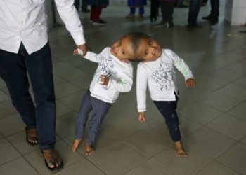 Médicos húngaros separan a gemelos de Bangladesh unidos por la cabeza
