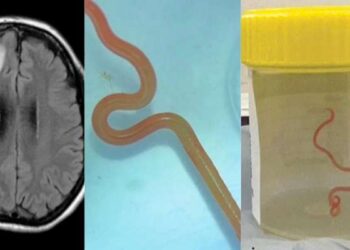 Científicos descubren por primera vez un gusano parásito en el cerebro de una persona