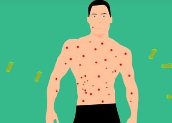 La OMS declara la viruela símica como emergencia sanitaria mundial en medio de un brote en África