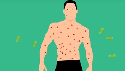 La OMS declara la viruela símica como emergencia sanitaria mundial en medio de un brote en África